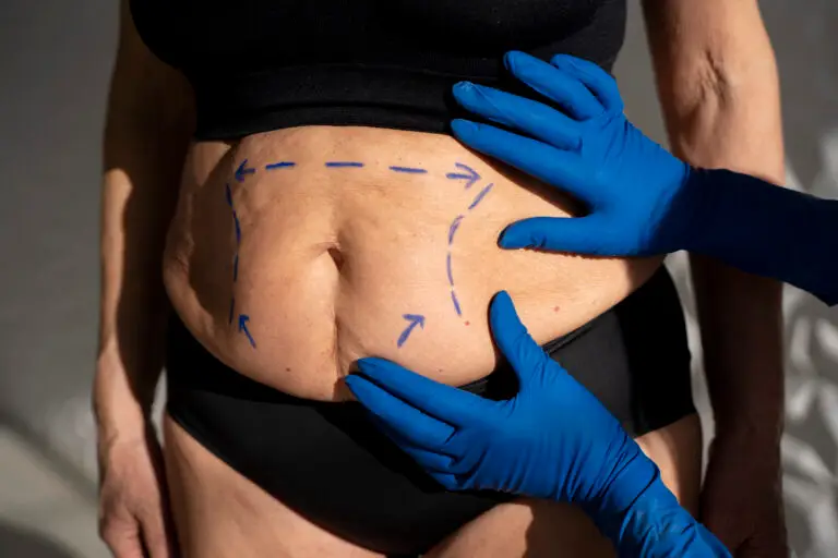 cirurgia reparadora pós bariátrica